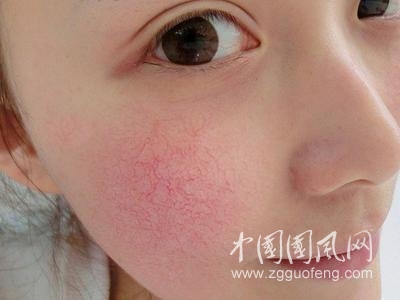 去除肌肤红血丝小妙招