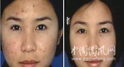 怎么消除痘印痘坑
